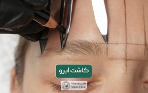 کاشت ابرو چیست و چه مزایایی دارد