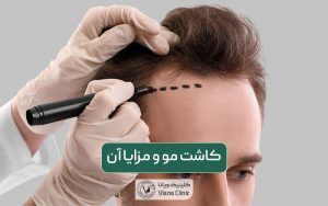 عمل زیبایی کاشت مو طبیعی چیست و چه مزایایی دارد