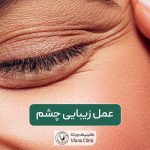 عمل زیبایی چشم در تهران؛ انواع جراحی زیبایی چشم و معرفی آن ها
