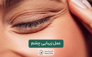 عمل زیبایی چشم در تهران؛ انواع جراحی زیبایی چشم و معرفی آن ها