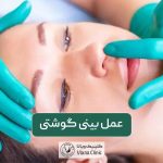عمل بینی گوشتی و انواع مراحل و روش های جراحی بینی پهن و گوشتی