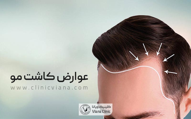 عوارض کاشت مو بر سر مردان و زنان