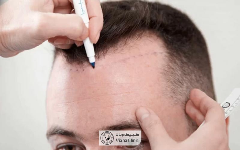 کاشت مو چیست و چه کاربردی دارد؟ معرفی انواع روش های کاشت مو