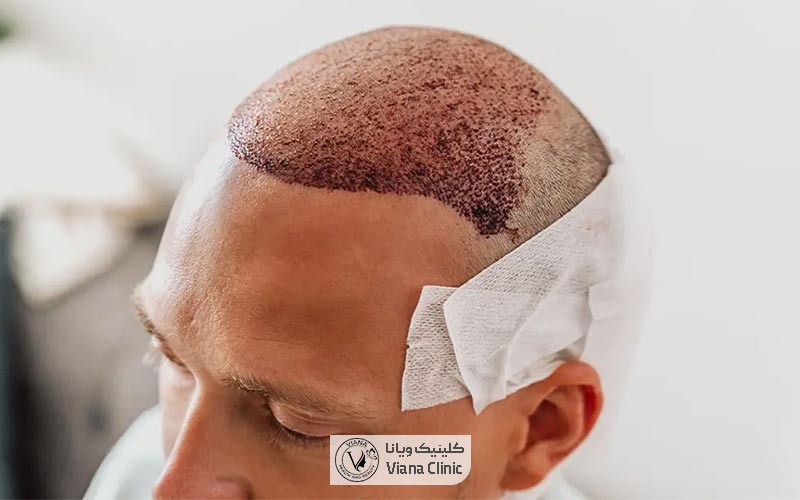 روش FIT یکی از انواع کاشت مو