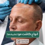 انواع کاشت مو در ایران؛ معرفی بهترین تکنیک‌ها و روش‌های کاشت موی سر مردان و زنان