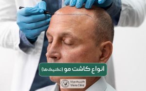 انواع کاشت مو در ایران؛ معرفی بهترین تکنیک‌ها و روش‌های کاشت موی سر مردان و زنان