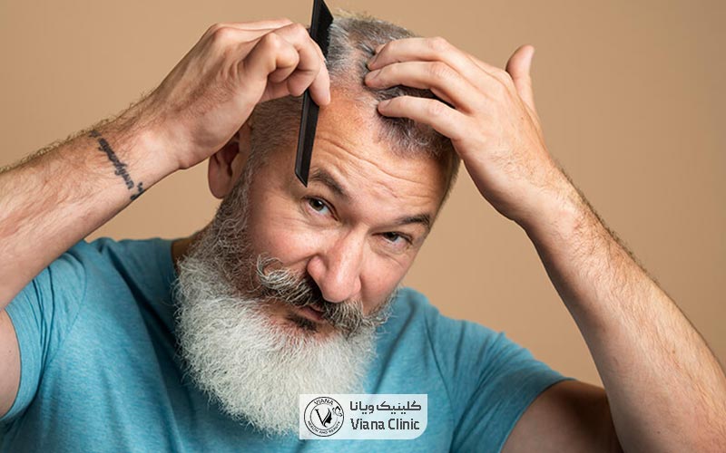 جدیدترین روش کاشت مو بدون بانک مو، استفاده از الیاف نانو است