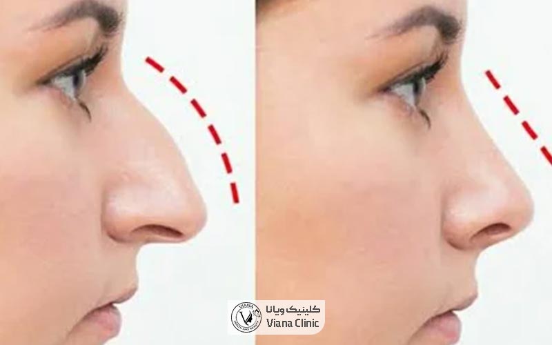 قیمت عمل بینی استخوانی و غضروفی در سال 1403 در تهران و عوامل موثر بر هزینه جراحی ان