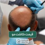قیمت کاشت مو و مراحل کاشتن موی سر در مردان و زنان در سال 1403