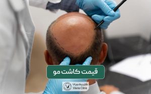 قیمت کاشت مو و مراحل کاشتن موی سر در مردان و زنان در سال 1403