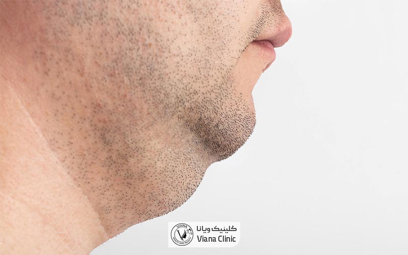 غبغب چیست و چه معایبی دارد