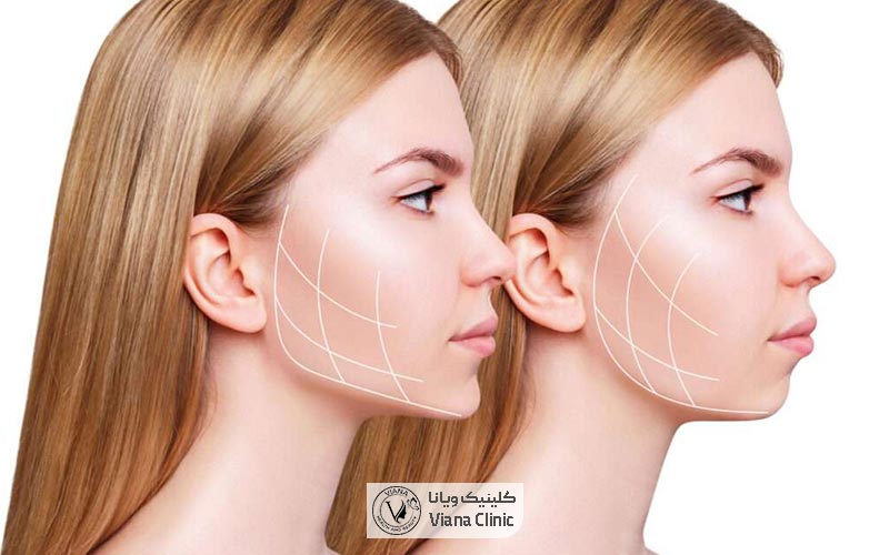 هزینه و قیمت عمل جراحی بوکال فت صورت در سال 1404