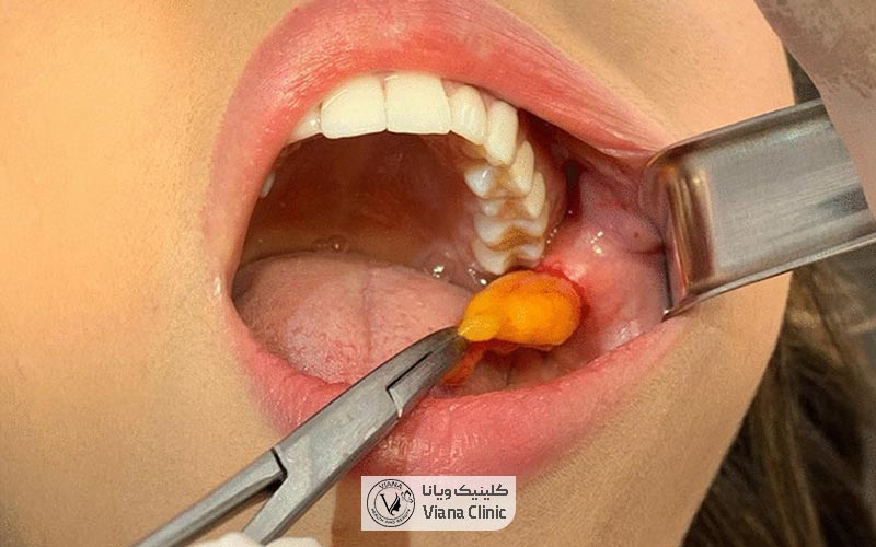 عمل بوکال فت صورت یا تخلیه چربی دهان و گونه چیست