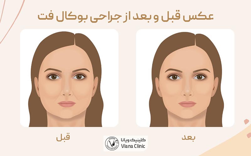تصویر و عکس قبل و بعد از عمل بوکال قت و تخلیه چربی دهان و گونه