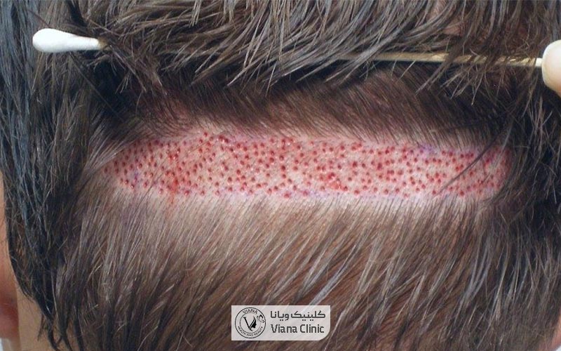 برای کاشت ابرو از کجا مو بر میدارند: موی پشت سر افراد بهترین گزینه برای کاشت ابرو اتس