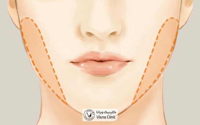 ایجاد فرورفتگی یا لاغری بیش از حد صورت یکی از عوارض تخلیه چربی بوکال در دراز مدت است