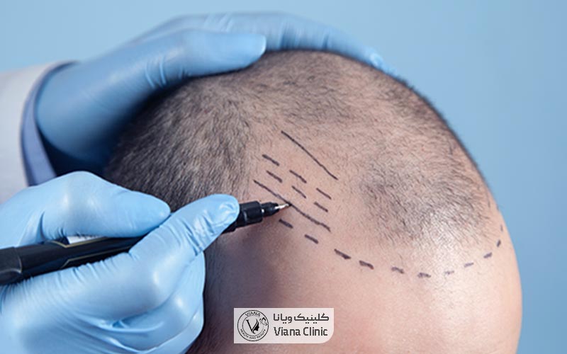مرگ در اثر کاشت مو صحت دارد؟