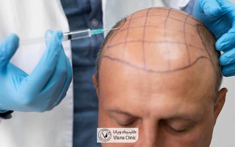 عوارض آمپول بی حسی در کاشت مو