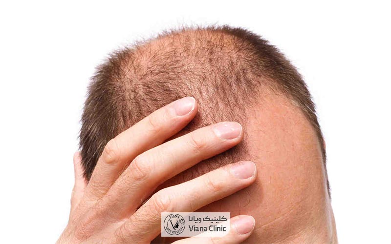 کاشت مو چیست و چه تکنیک‌هایی برای کاشت آن وجود دارد