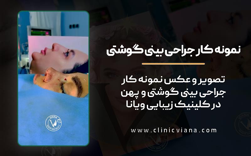 عکس نمونه کار واقعی قبل و بعد از عمل جراحی بینی گوشتی و پهن