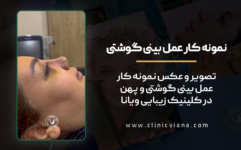 تصویر بعد از عمل جراحی بینی و دماغ گوشتی و پهن در کلینیک ویانا