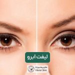 لیفت ابرو چیست؟ معرفی انواع روش های لیفت ابرو طبیعی زنان و مردان