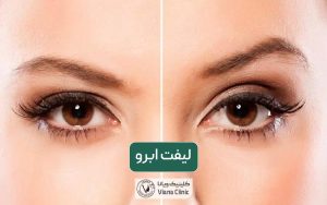 لیفت ابرو چیست؟ معرفی انواع روش های لیفت ابرو طبیعی زنان و مردان