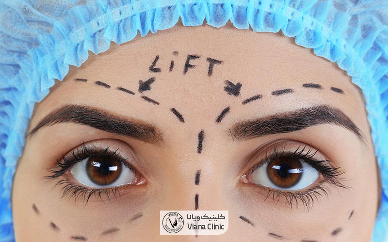 لیفت ابرو با روش آندوسکوپی یکی از روش های کم تهاجمی است