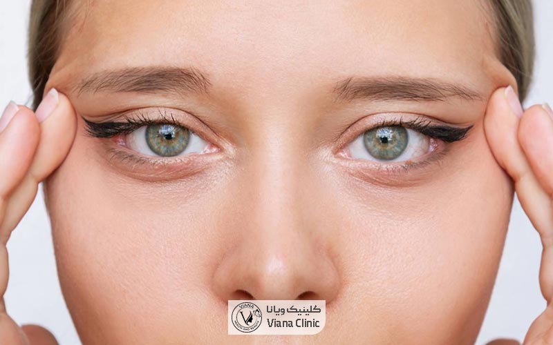 جراحی چشم گربه ای یا عمل کانتوپلاستی چشم چیست