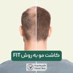 کاشت مو به روش FIT طبیعی به همراه مزایا و عوارض آن