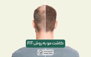 کاشت مو به روش FIT طبیعی به همراه مزایا و عوارض آن