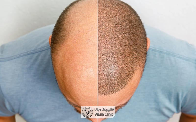 کاشت مو به روش FIT به صورت طبیعی و اهداف آن