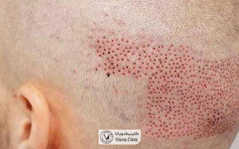 عوارض کاشت مو و بررسی علل ایجاد آن