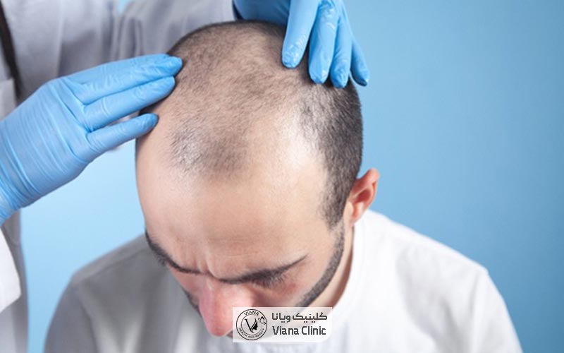 استخراج فولیکول ها و گرافت ها در روش FUE کاشتن موی سر