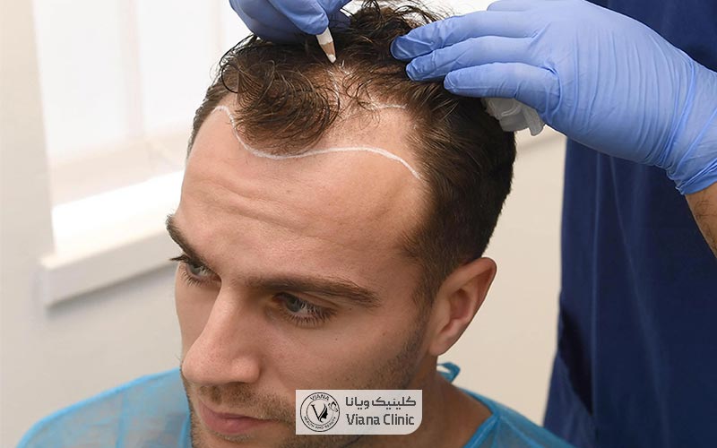 آماده سازی قبل از عمل کاشت مو یکی از مراحل کاشتن موی سر طبیعی به روش FUE است