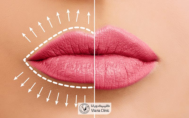 فیلر یا ژل لب چیست و چه کاربردهایی دارد