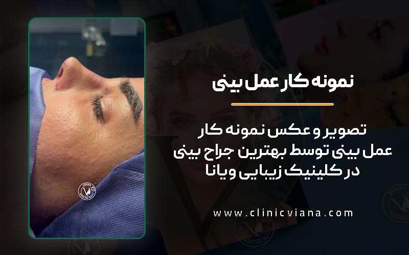تصویر و عکس نمونه کار جراحی بینی توسط بهترین دکتر عمل بینی طبیعی در غرب تهران