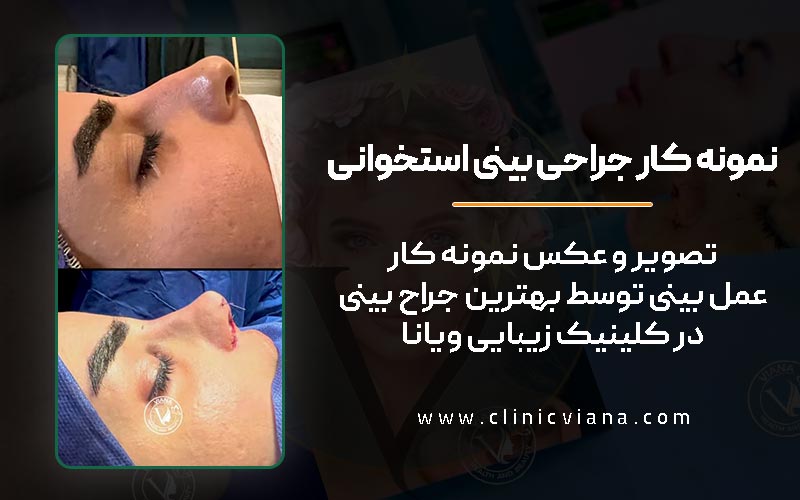 نمونه کار واقعی اتاق عمل جراحی بینی استخوانی توسط بهترین دکتر عمل بینی در ستارخان تهران