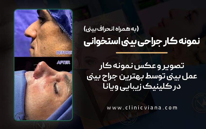 عکس و فیلم نمونه کار واقعی جراحی بینی استخوانی همراه با انحراف بینی توسط بهترین جراح بینی تهران