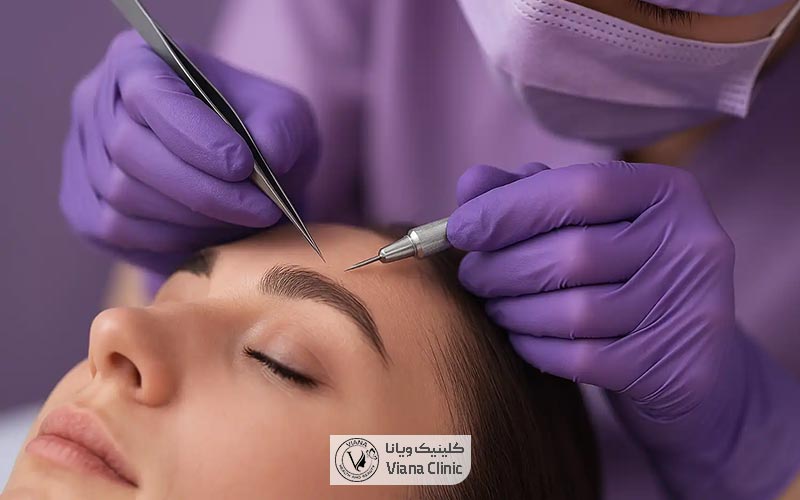 کاشت ابرو به روش میکروفیت چیست و چگونه انجام میشود؟ مزایا و معایب روش میکرو گرافت