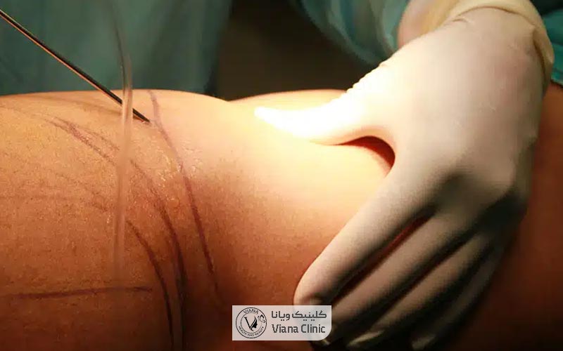 بهترین نفرات برای تزریق چربی کیست و چه شرایطی دارد