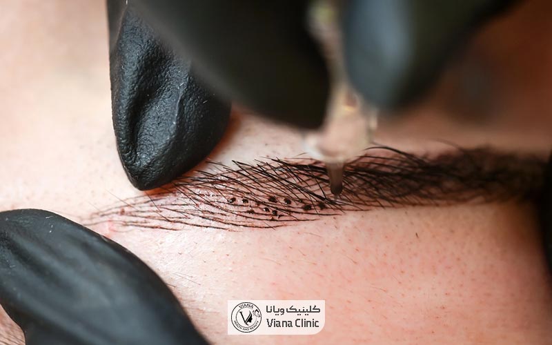 کاشت ابرو بهتر است یا میکروبلیدینگ ابرو؟