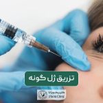 تزریق ژل گونه و مراحل انجام آن به همراه مزایا و عوارش فیلر گونه