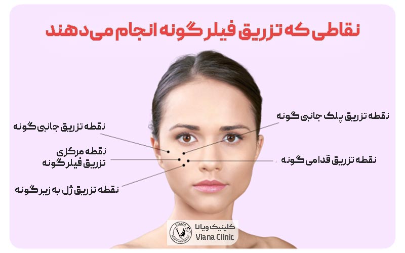 نقاطی که ژل گونه و فیلر گونه را تزریق می‌کنند
