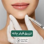 تزریق ژل چانه به همراه ماندگاری، عوارض و هزینه تزریق فیلر چانه و چونه در سال 1404