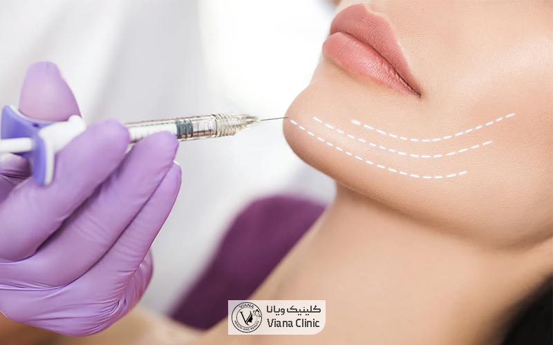 هزینه تزریق ژل چانه در سال 1404 و بررسی قیمت فیلر چانه در شهر تهران