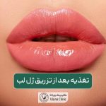 غذا خوردن بعد از تزریق ژل لب و نکات مهم مراقبتی بعد از آن