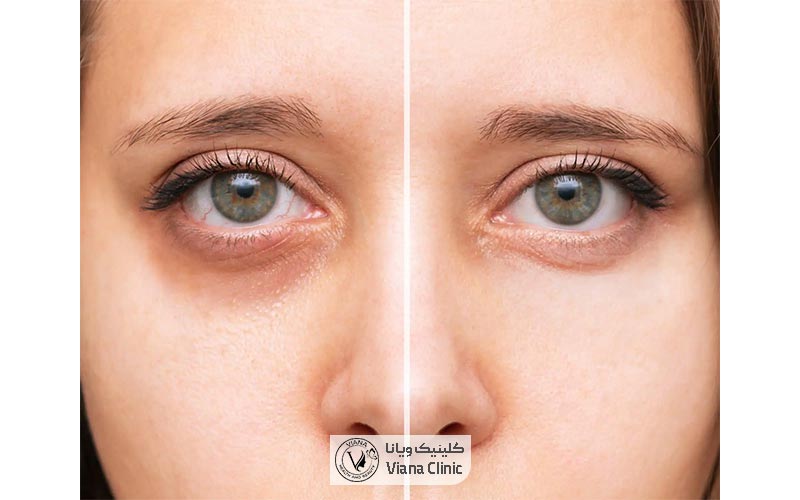 کربوکسی تراپی چیست؟ عکس نمونه قبل و بعد از کربوکسی تراپی صورت زنان