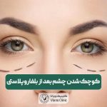 علت کوچک شدن چشم بعد از بلفاروپلاستی و درمان خانگی آن
