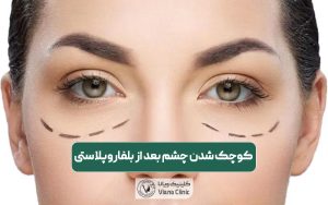 علت کوچک شدن چشم بعد از بلفاروپلاستی و درمان خانگی آن
